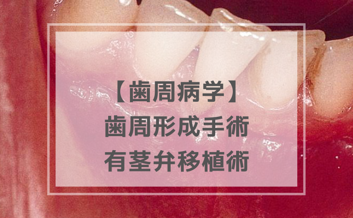 歯周病学：有茎弁移植術（計2問）【歯科医師国家試験】（2025年10月22