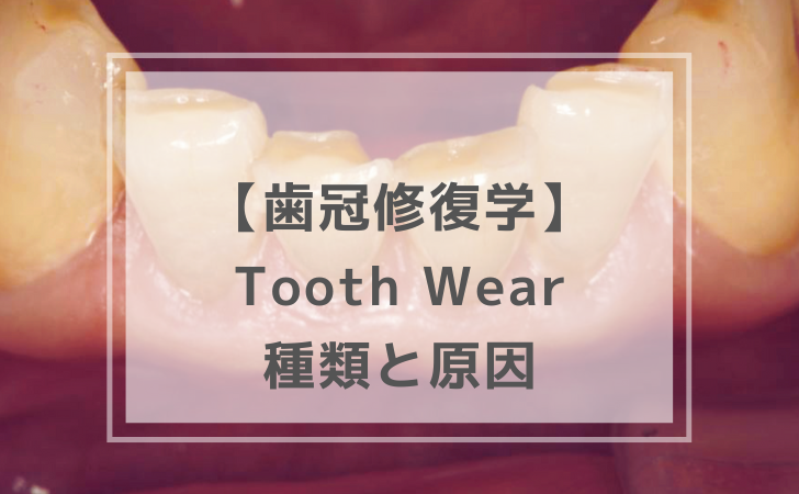 Tooth Wearとその原因（計5問）｜歯冠修復学【歯科医師国家試験