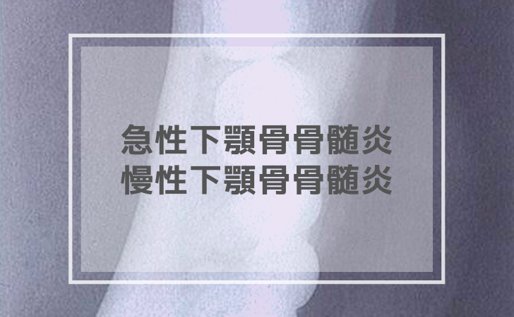 急性 慢性下顎骨骨髄炎 19年11月22日更新 口腔外科学 Dental Youth Share