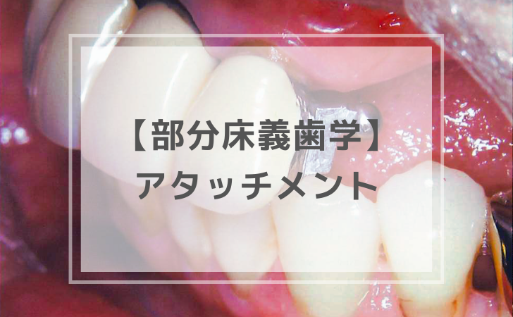 国家試験対応一式 部分床義歯学：アタッチメント（計4問）【歯科医師国家試験】（2026年3