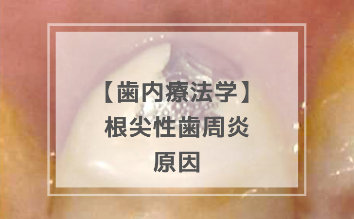 歯冠修復学：根尖性歯周疾患の原因（計4問）【歯科医師国家試験