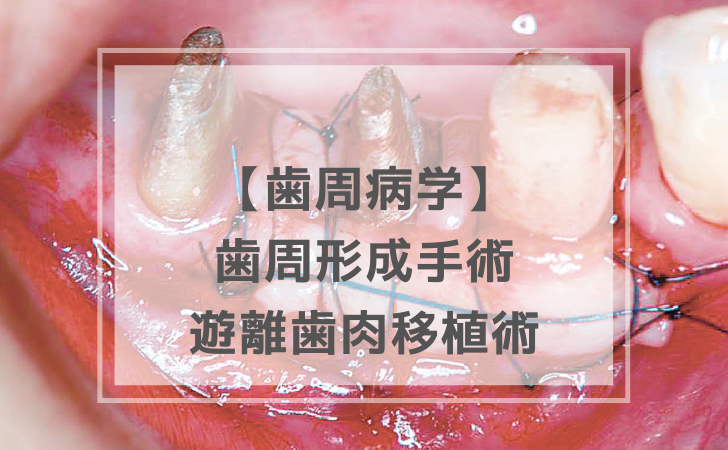 歯周病学：遊離歯肉移植術（計8問）【歯科医師国家試験】（2025年10月