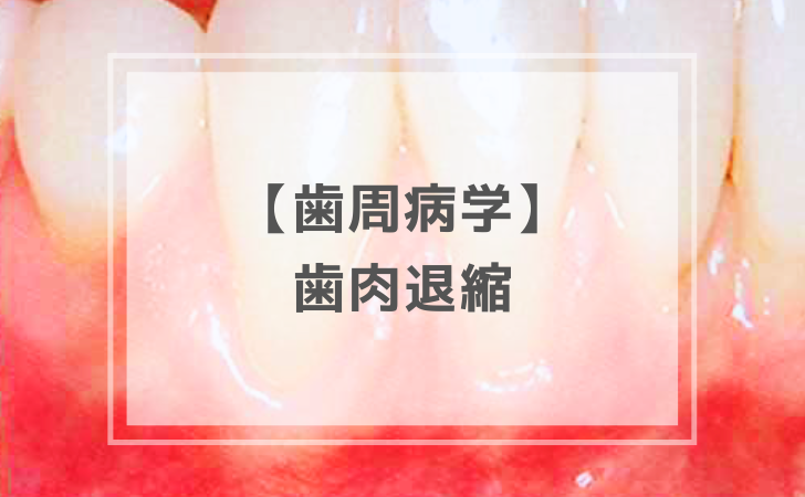 歯周病学：歯肉退縮（計5問）【歯科医師国家試験】（2025年10月29日