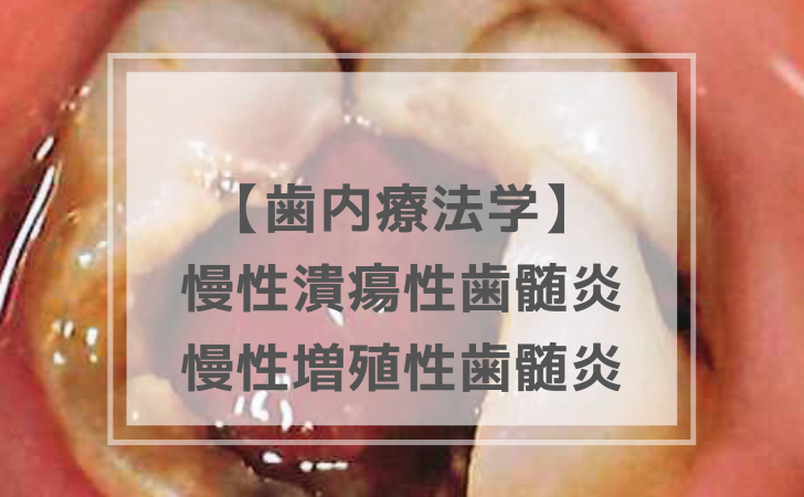 歯内療法学：慢性潰瘍性歯髄炎・慢性増殖性歯髄炎（計4問）【歯科医師