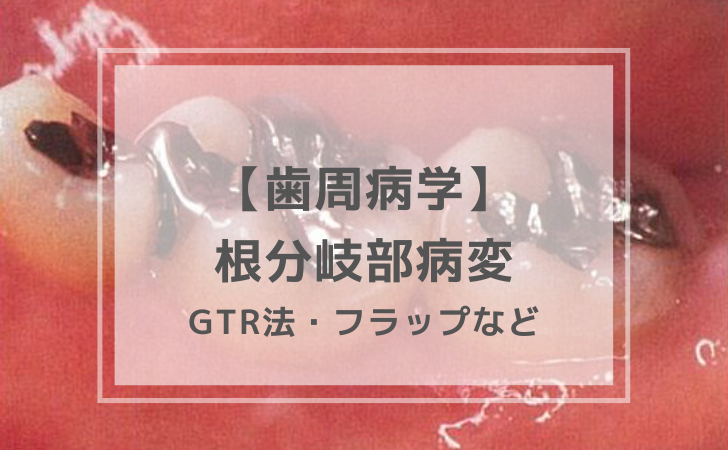 歯周病学：根分岐部病に対するGTR法・フラップなど（計3問）【歯科医師