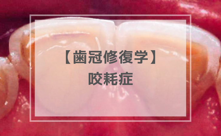 咬耗症：特徴と対応（計5問）｜歯冠修復学【歯科医師国家試験