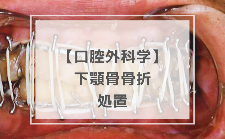 口腔外科学：下顎骨骨折の処置（計21問）【歯科医師国家試験】（2025年